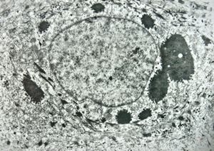 F, 11y. | ichthyosis hystrix type Curth-Macklin F, 11y. | ichthyosis hystrix type Curth-Macklin